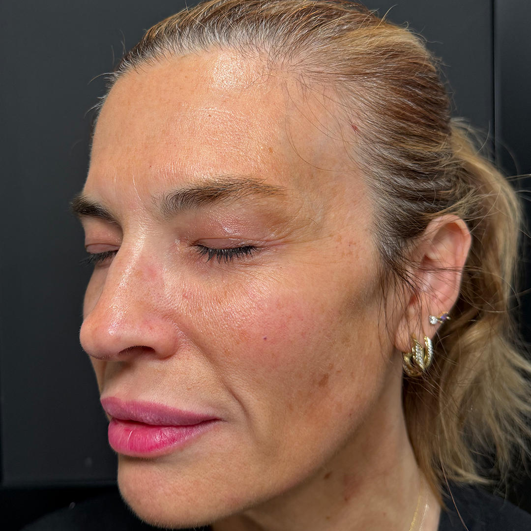 Anti-aging laser treatment in Metairie | Chronos Med Spa