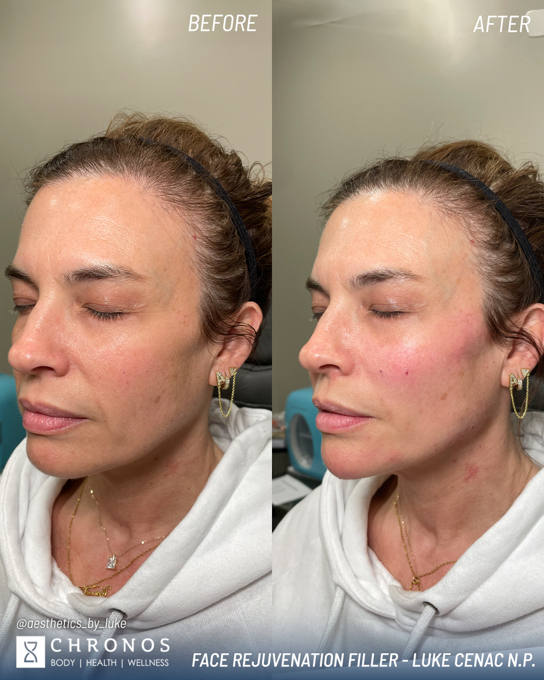 Dermal filler transformation with aesthetic injections in Metairie, LA | Chronos BHW
