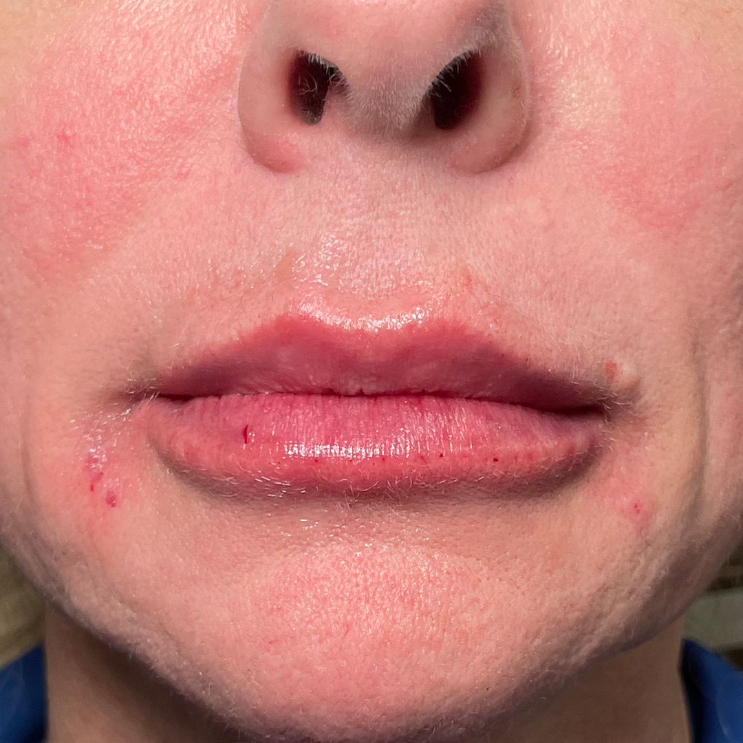 Lip enhancement filler | After lip filler results in Metairie, LA | Chronos BHW