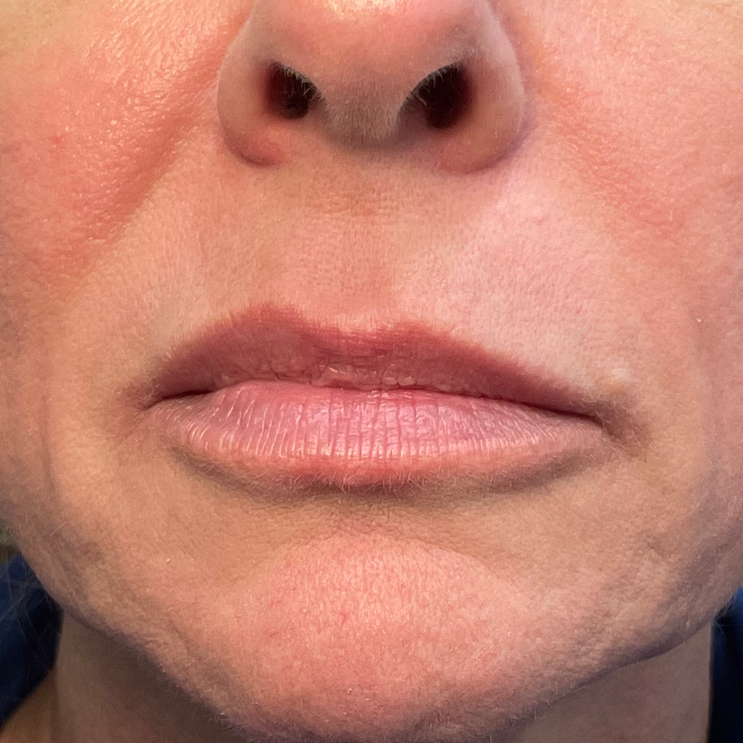 Lip enhancement filler | Before lip filler results in Metairie, LA | Chronos BHW