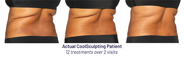 CoolSculpting Elite and body contouring results in Metairie, LA | Chronos BHW