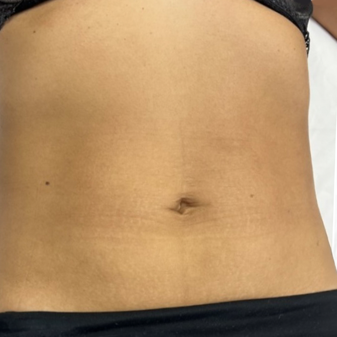 After CoolSculpting in Metairie, LA at Chronos BHW | Belly fat treatment | Non-invasive fat loss