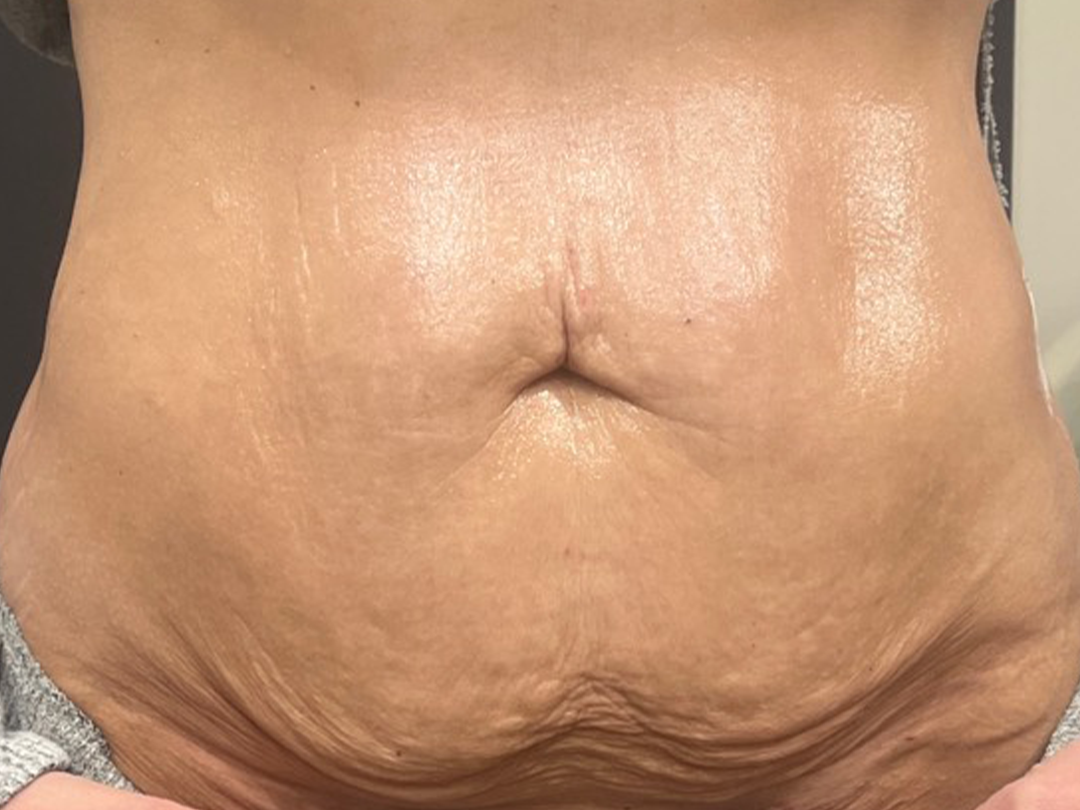 Body RF transformation in Metairie, LA at Chronos BHW | Virtue RF results |