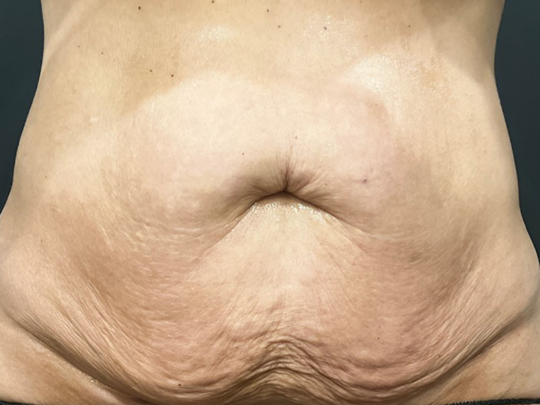 Before photos of Body RF services in Metairie, LA at Chronos BHW | Loose belly skin