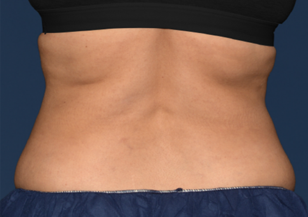 After CoolSculpting in Metairie, LA at Chronos BHW | CoolSculpting Elite results | Back Flanks