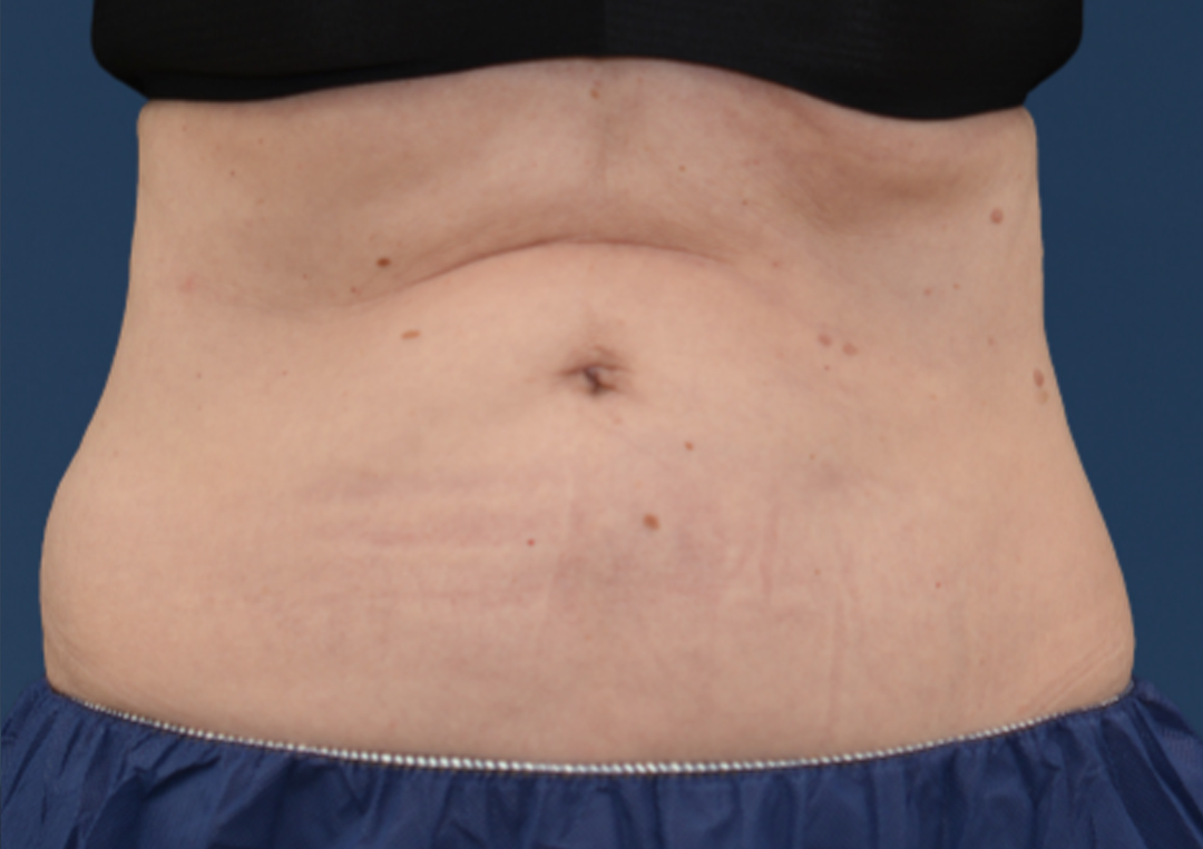 After CoolSculpting in Metairie, LA at Chronos BHW | Abdomen body contouring