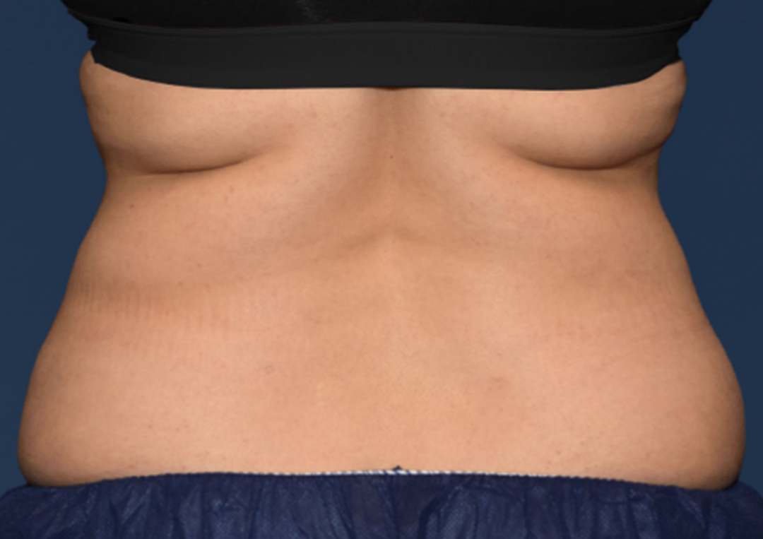 Before CoolSculpting Elite in Metairie, LA at Chronos BHW | Back flank treatments