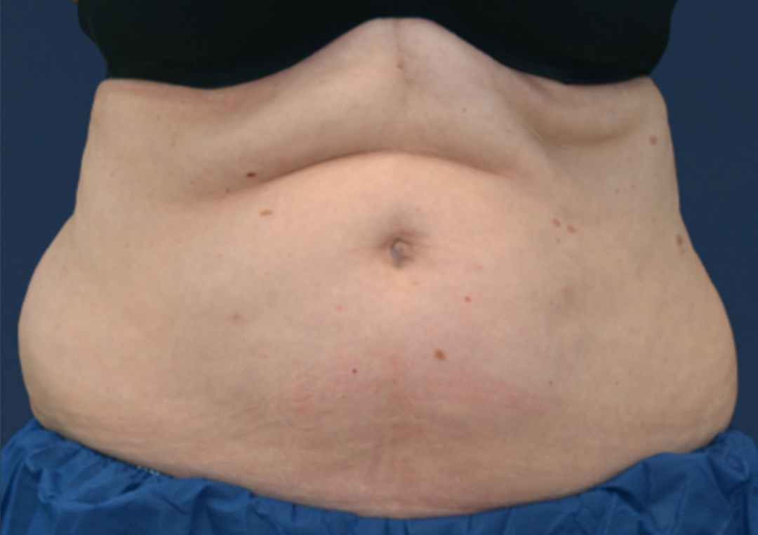 Before CoolSculpting in Metairie, LA at Chronos BHW | Abdomen body contouring