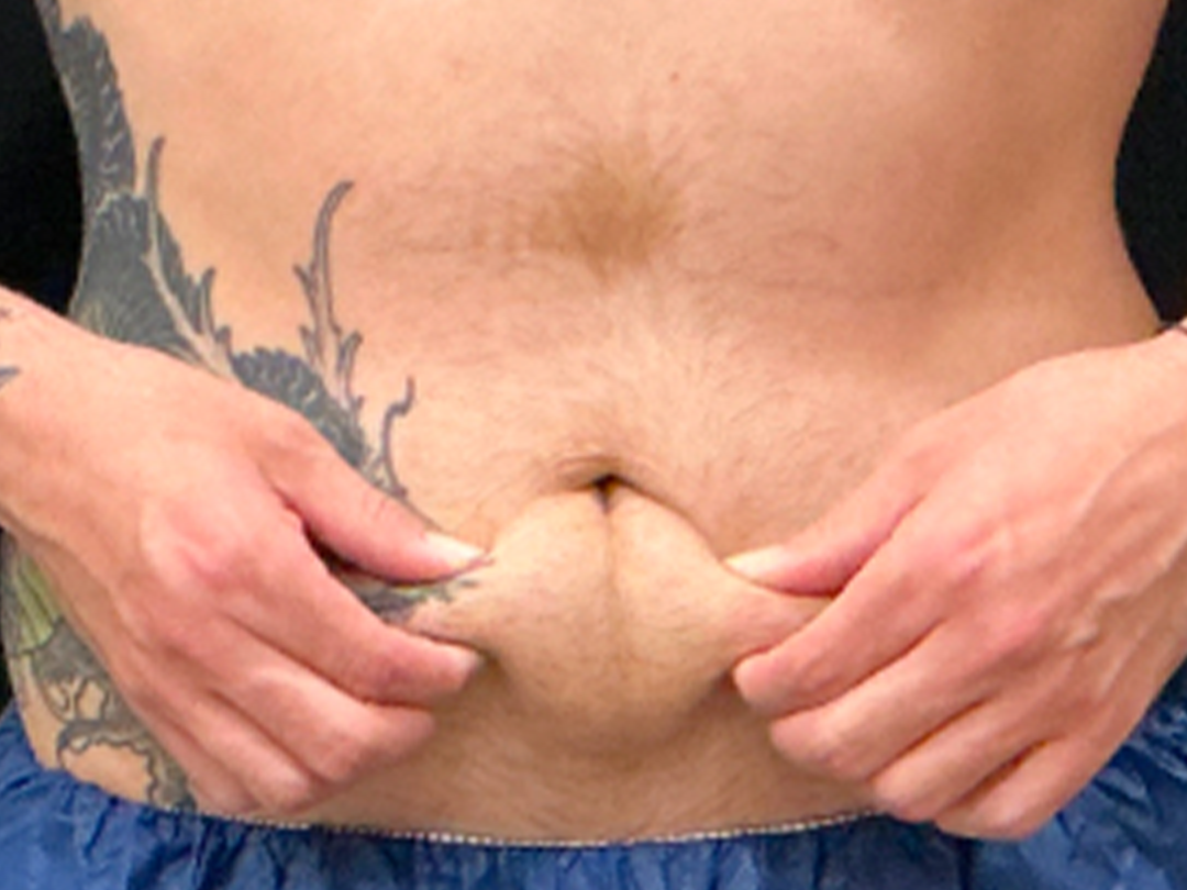 After CoolSculpting in Metairie, LA at Chronos BHW | Belly fat treatment | Non-invasive fat loss