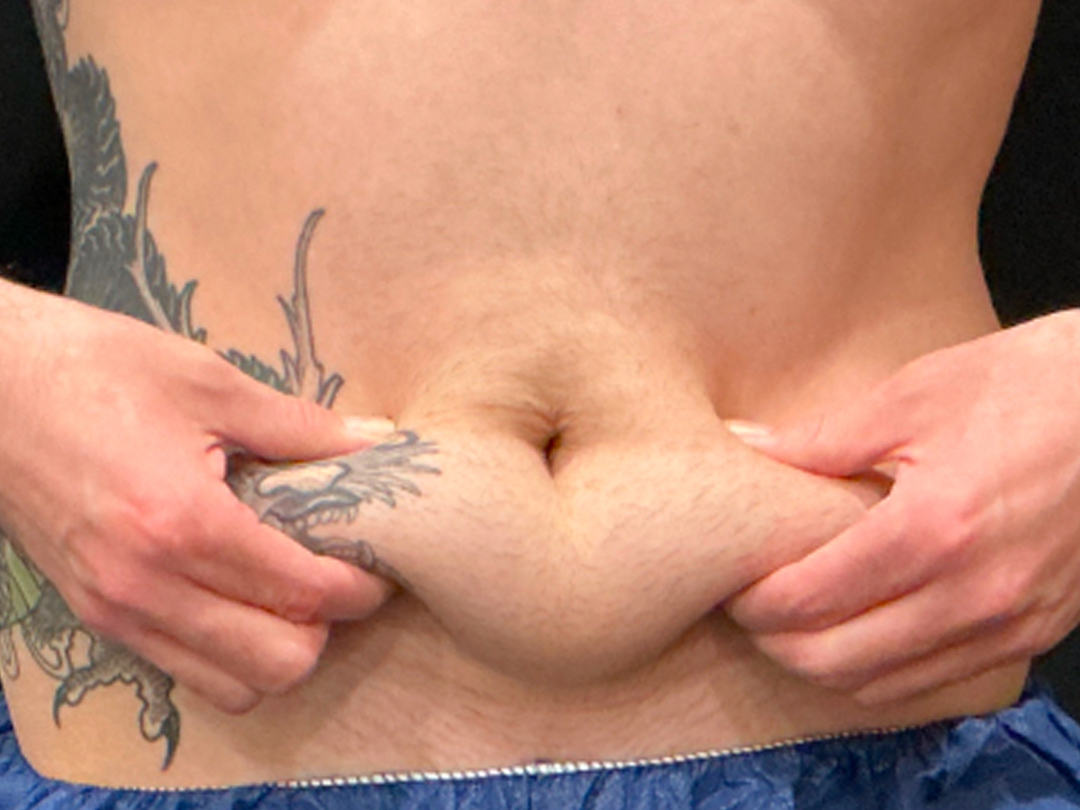 CoolSculpting before | Stubborn belly fat treatment | Metairie, LA
