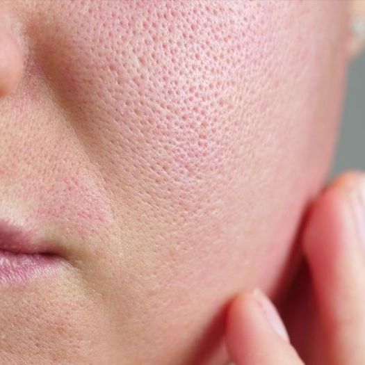 Large pore and rough texture treatments in Metairie | Chronos BHW