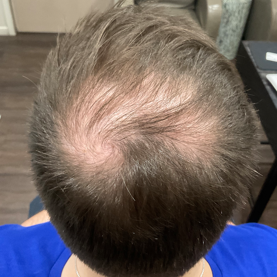 hair transformation | Thin hair treatment results | After photo | Chronos BHW