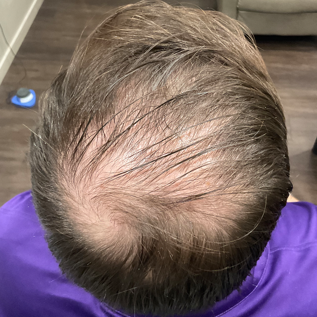 Hair restoration service transformation | Before photos | Chronos BHW | Metairie, LA