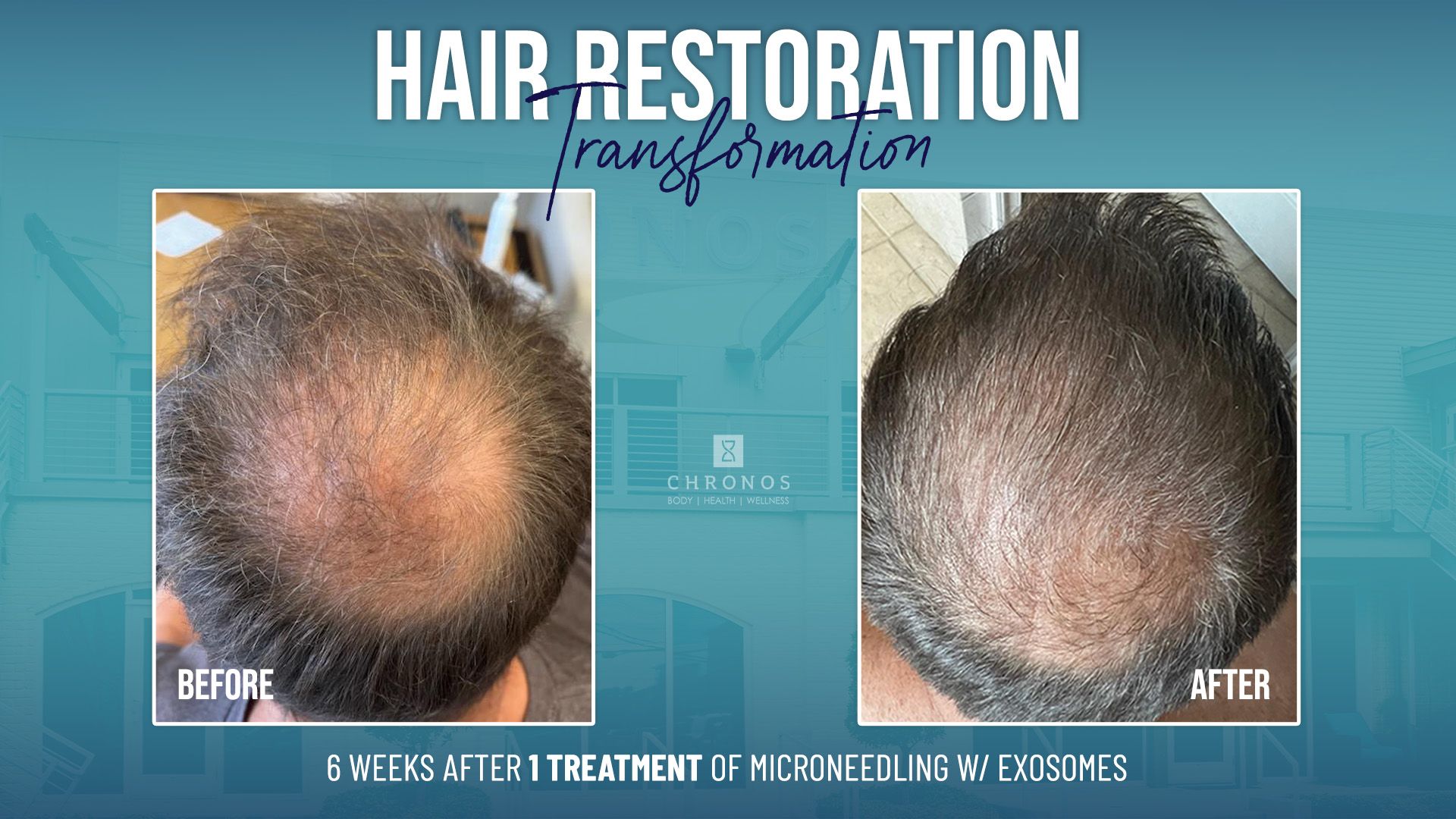 Hair regrowth treatment in metairie | Chronos BHW | Thinning hair treatments