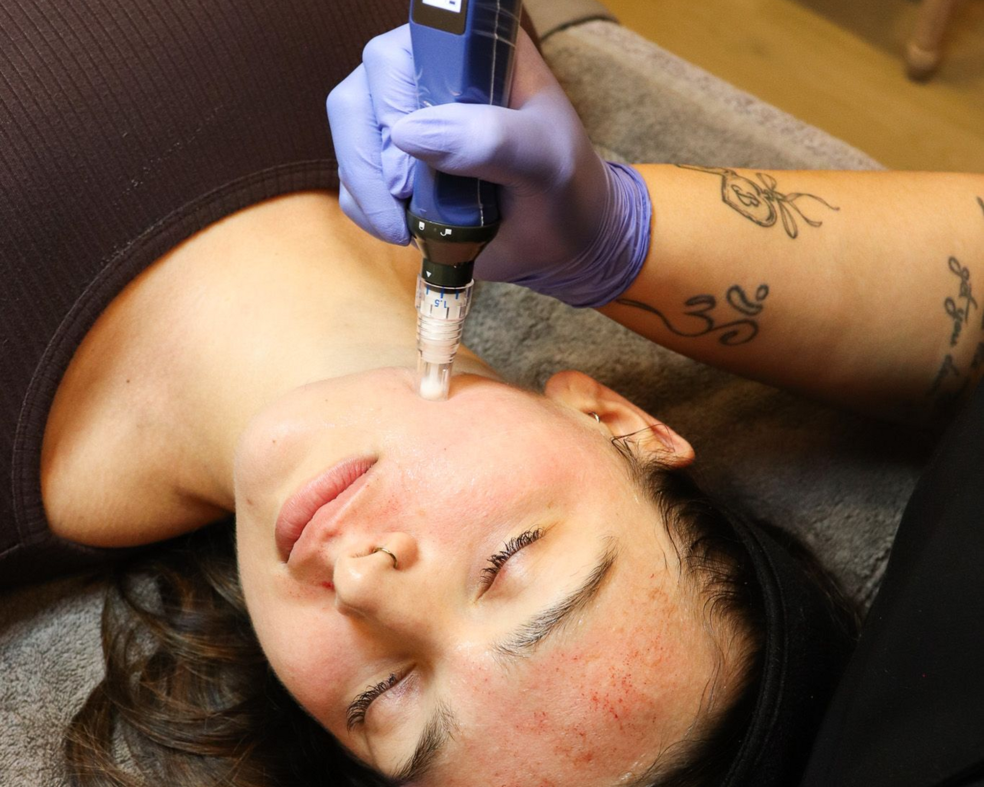 SkinPen microneedling for fine lines, acne, and more at Chronos BHW in Metairie, LA