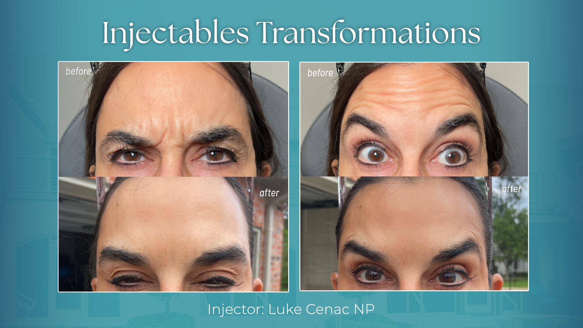 Dysport near me in Metairie, LA at Chronos BHW | Botox injections