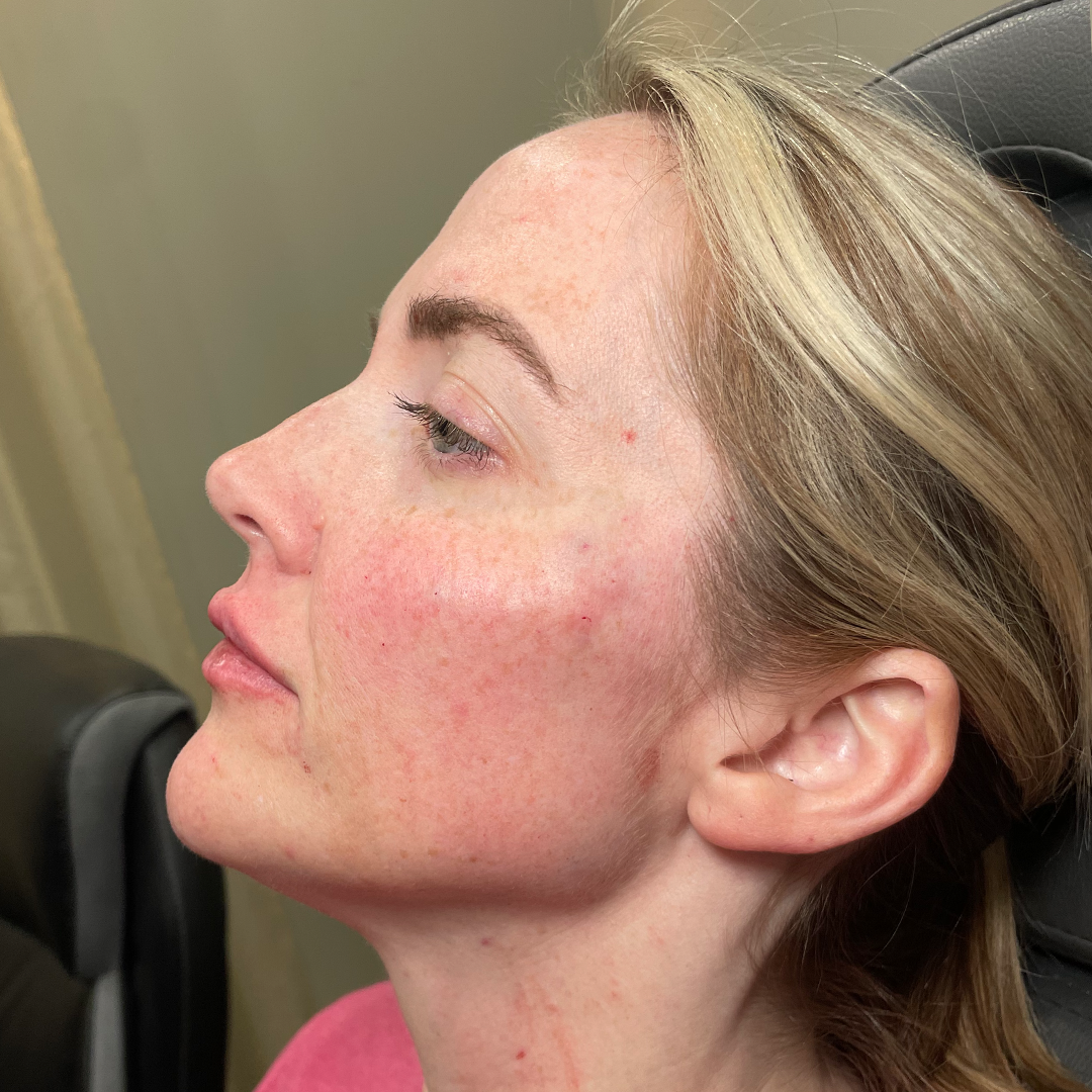 After dermal chin and jaw filler | Natural filler results in Metairie | Chronos BHW