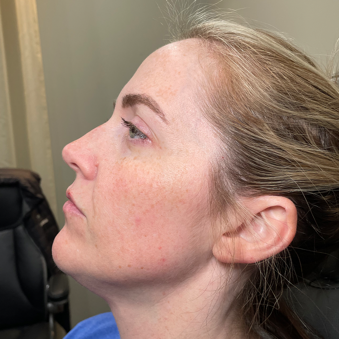 Natural jaw & chin filler | Jaw snatch treatment | Double chin treatment | Metairie, LA | Chronos BHW