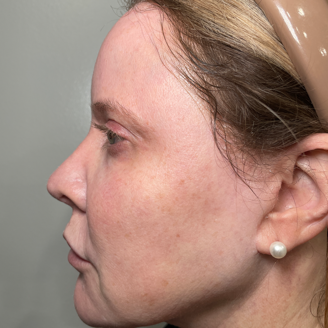 Moxi & BBL Treatments in Metairie | Chronos BHW | Sciton Laser treatments