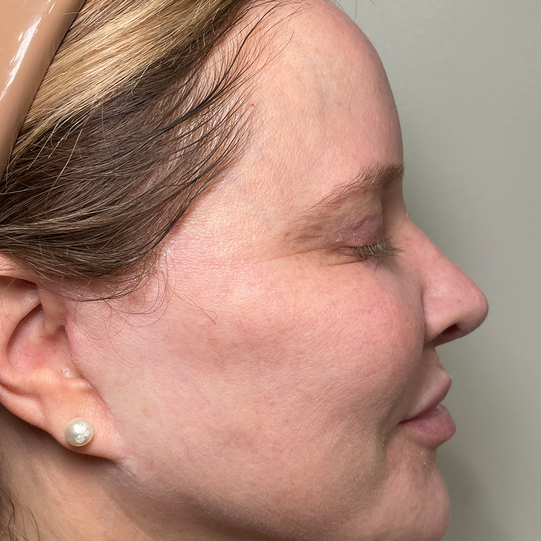 before MOXI laser treatment | Chronos BHW in Metairie Laser treatment