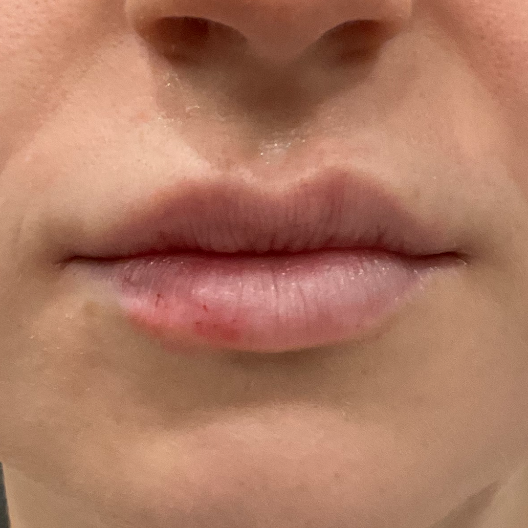 Natural lip filler transformation | Lip plump treatment | Metairie, LA | Chronos BHW