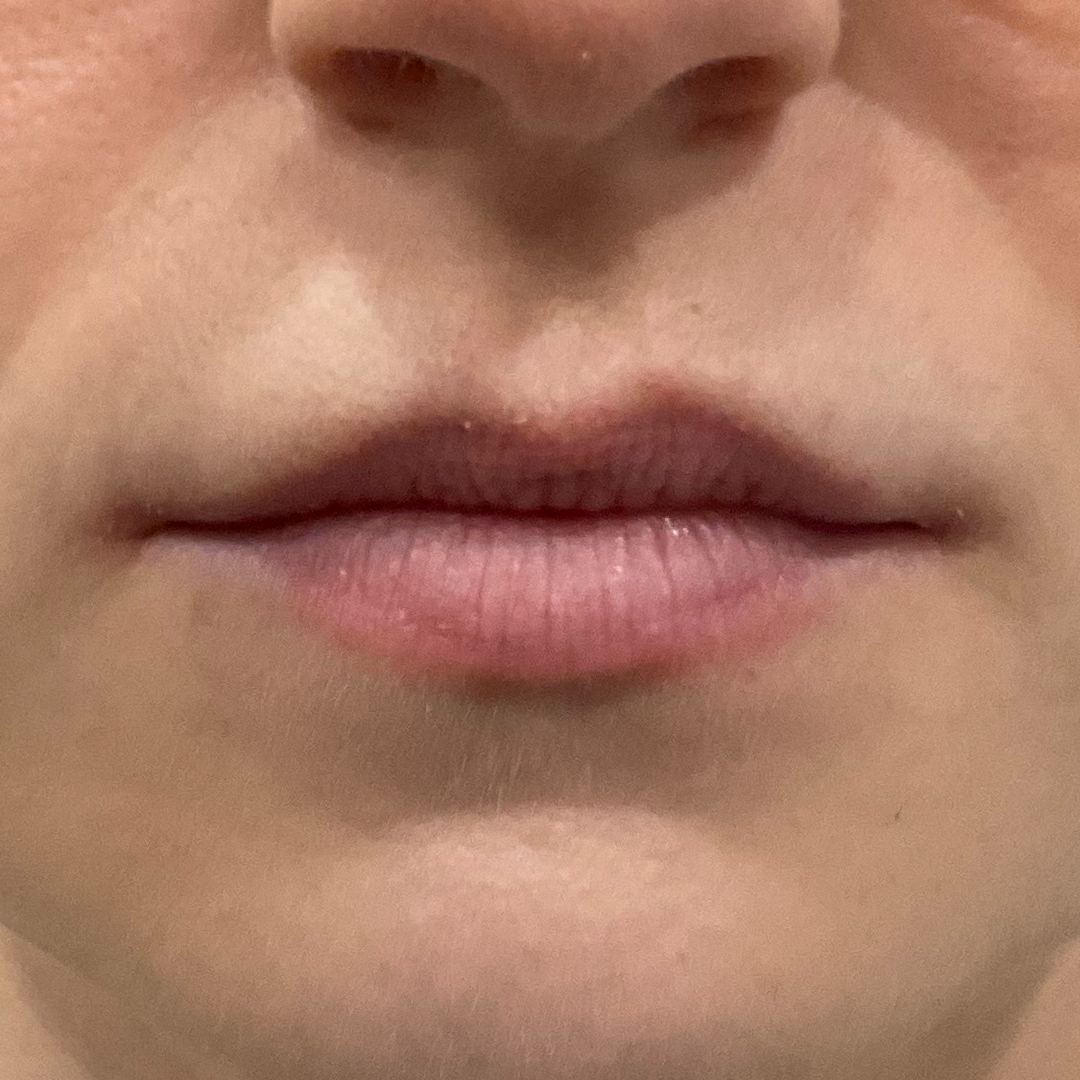 Before natural lip filler | Subtle lip filler in Metairie, LA | Chronos BHW