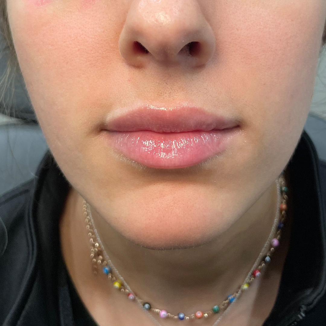 After Lip filler in Metairie, LA at Chronos BHW | Lip Filler results | Lip enhancement