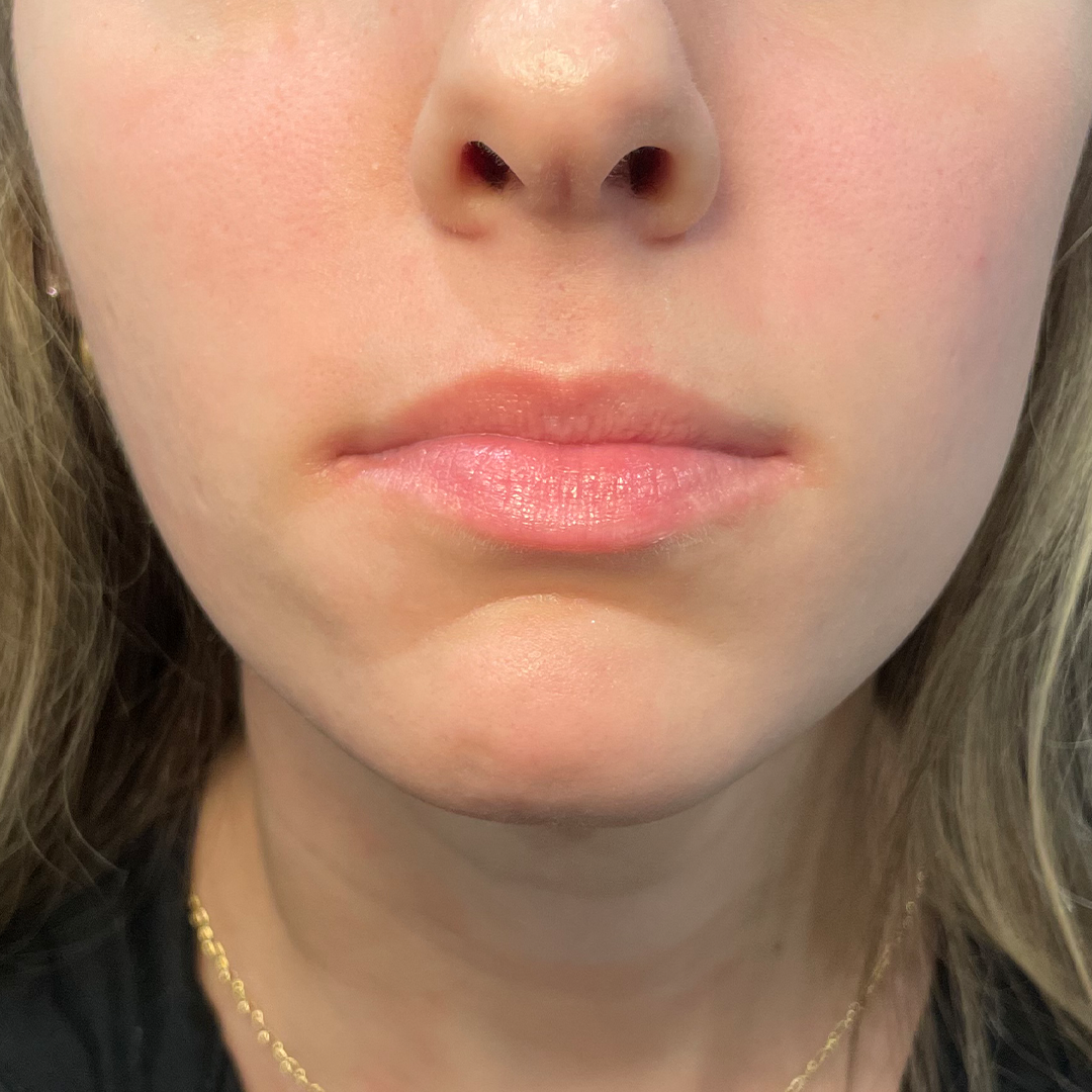 Before Lip filler in Metairie, LA at Chronos BHW | Before lip treatment