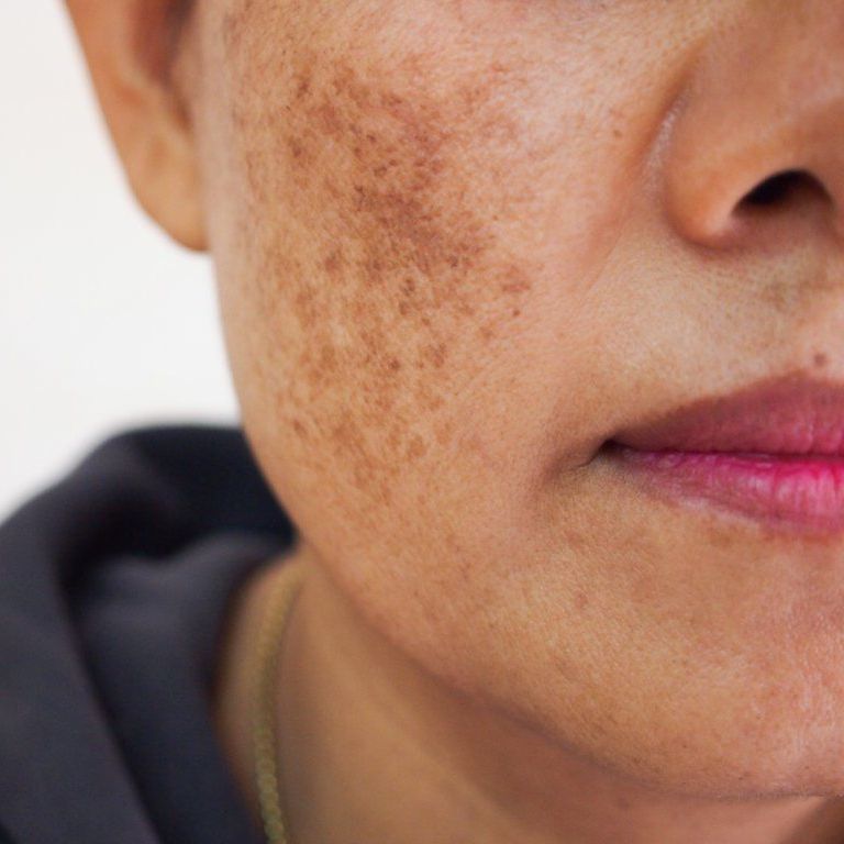 Treat sun damage, dark spots, and hyperpigmentation at Med spa Chronos BHW in Metairie, LA