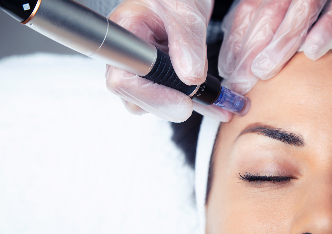 Microneedling treatment in Metairie, LA | Skin rejuvenation at Chronos BHW
