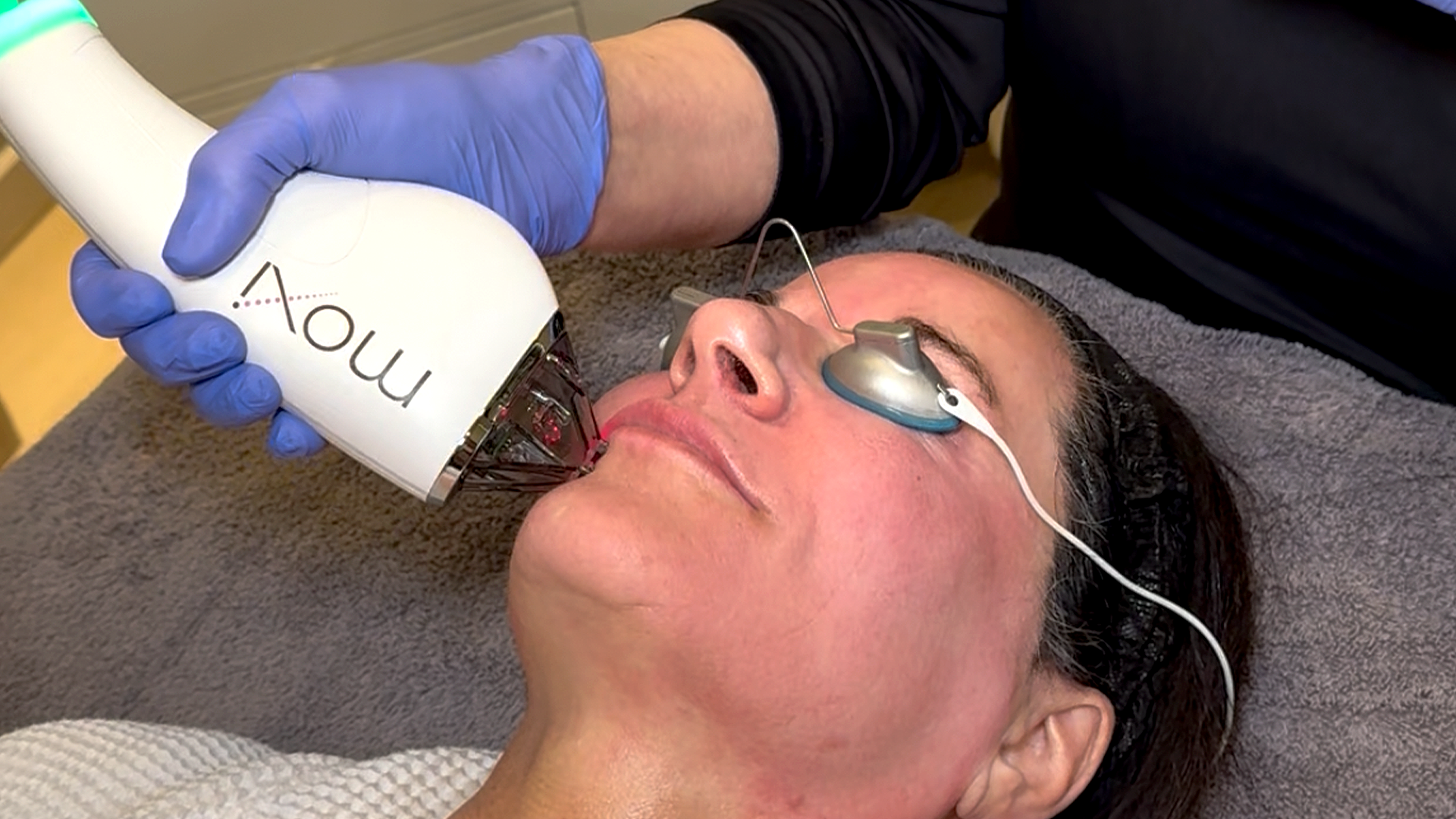 Moxi laser treatment at Chronos Body Health in Metairie, LA | Anti-aging laser treatments