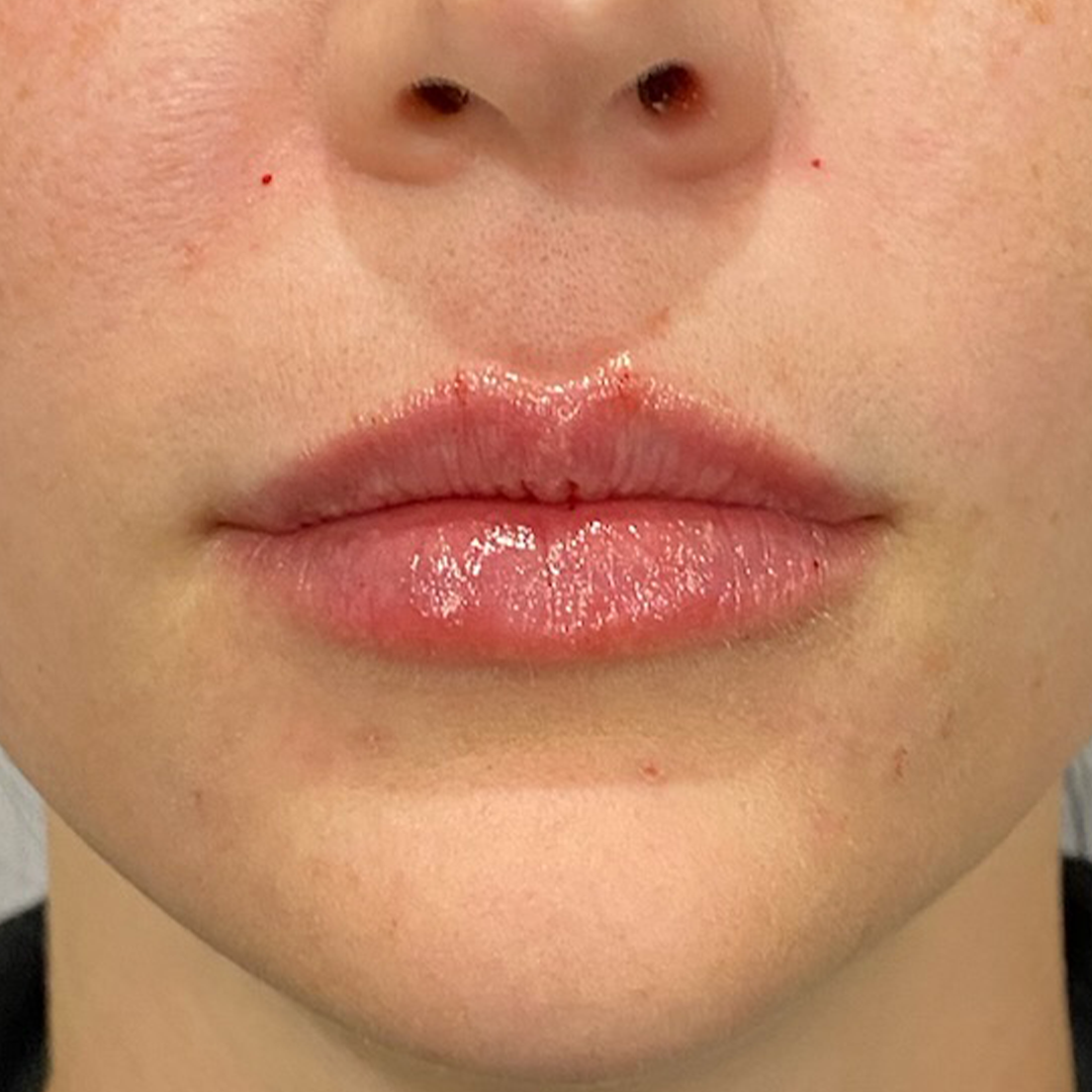Natural lip filler Metairie | Aesthetic Injector | Chronos BHW
