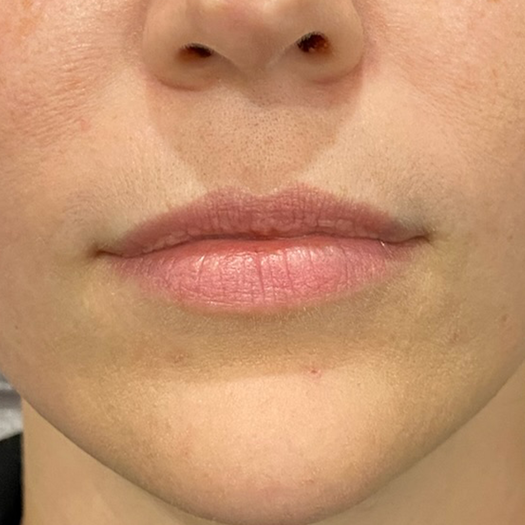 Aesthetic Injector | Lip filler Metairie | Chronos BHW
