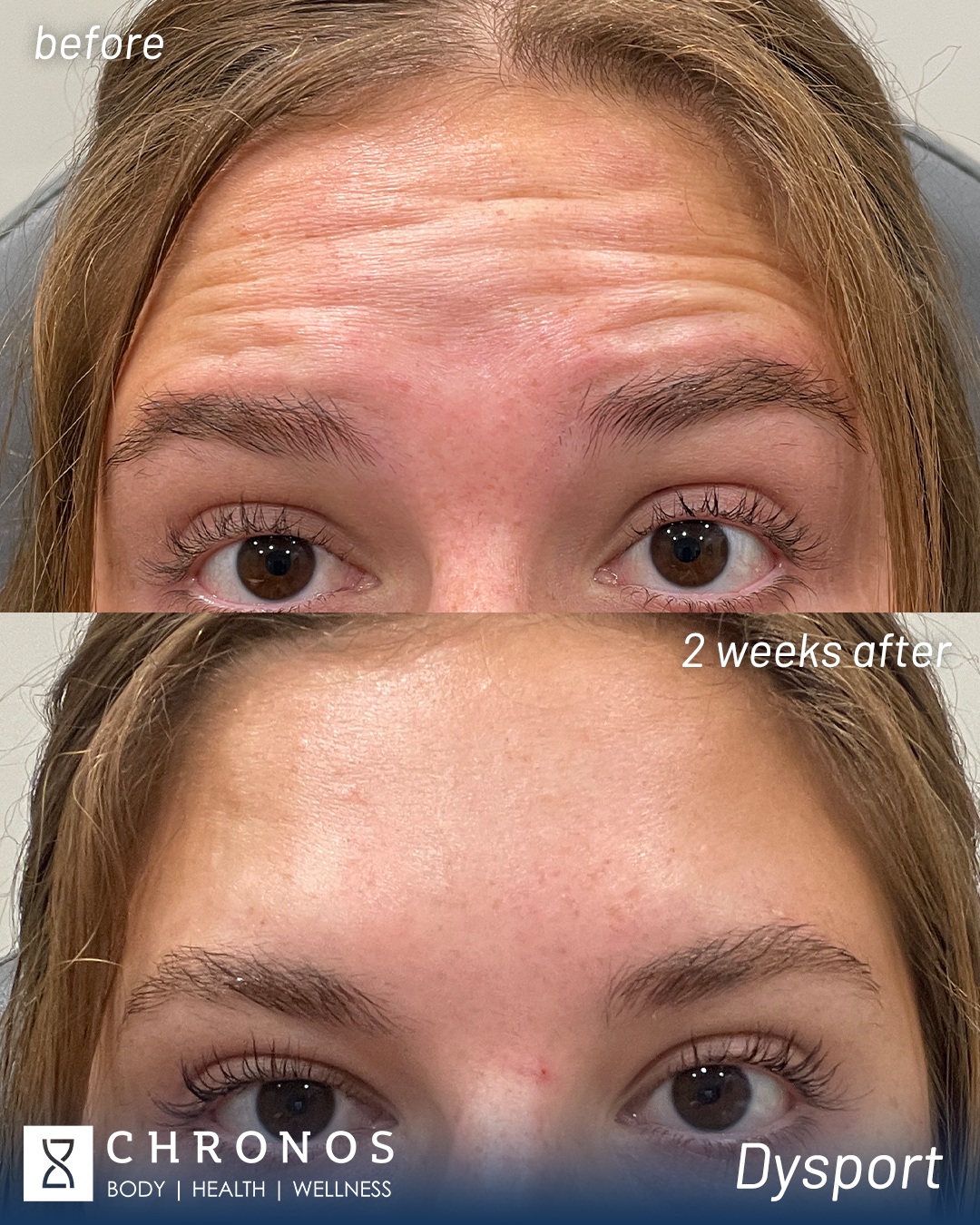 Dysport results | Botox in Metairie | Chronos BHW