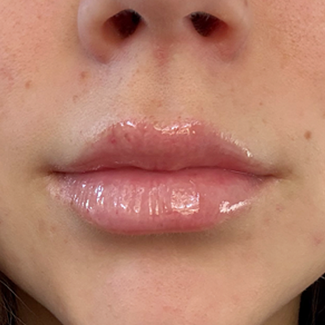 Lip filler results in Metairie | Chronos BHW | Metairie Injector