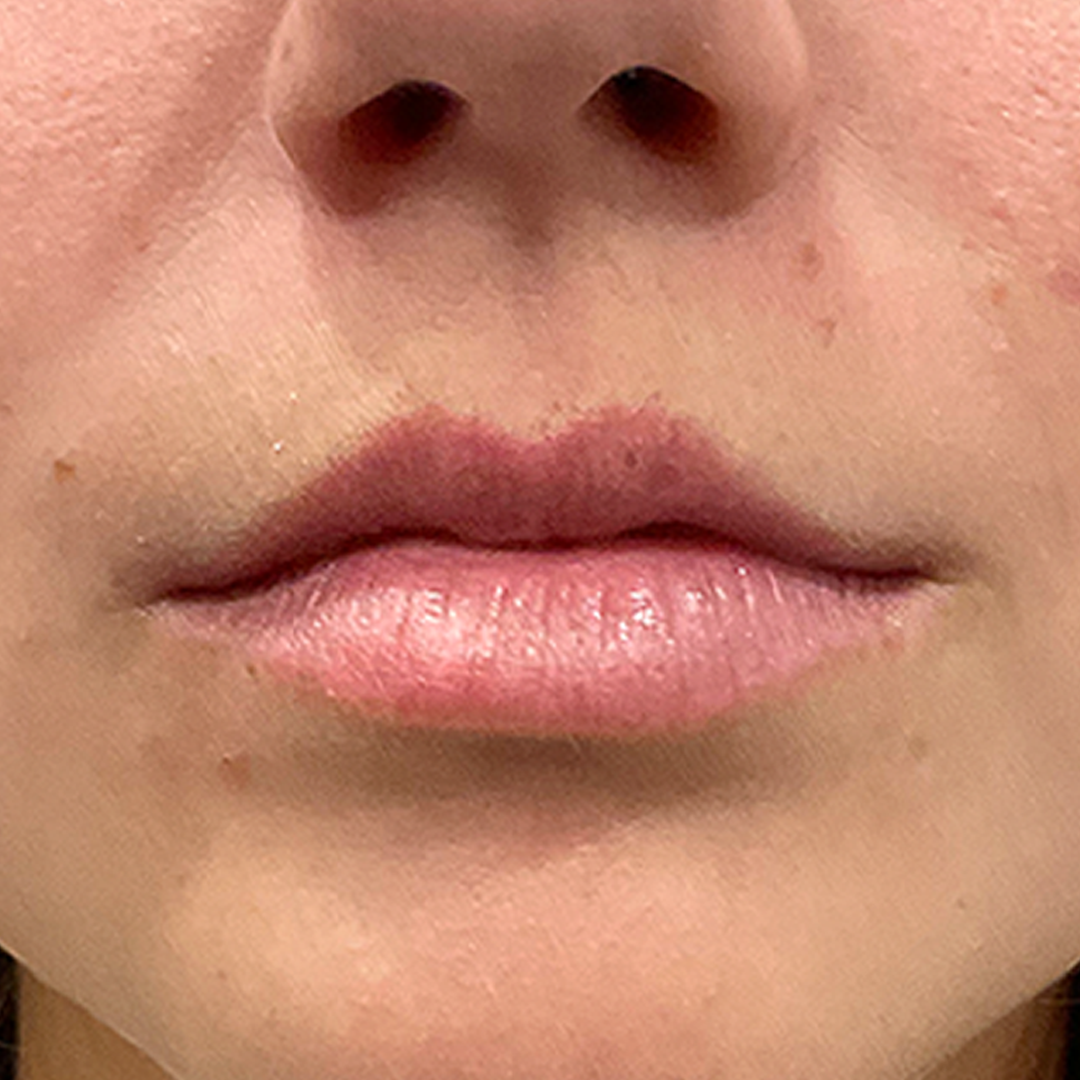 Before Kysse Lip filler in Metairie at Chronos BHW | Lip Filler tranformation