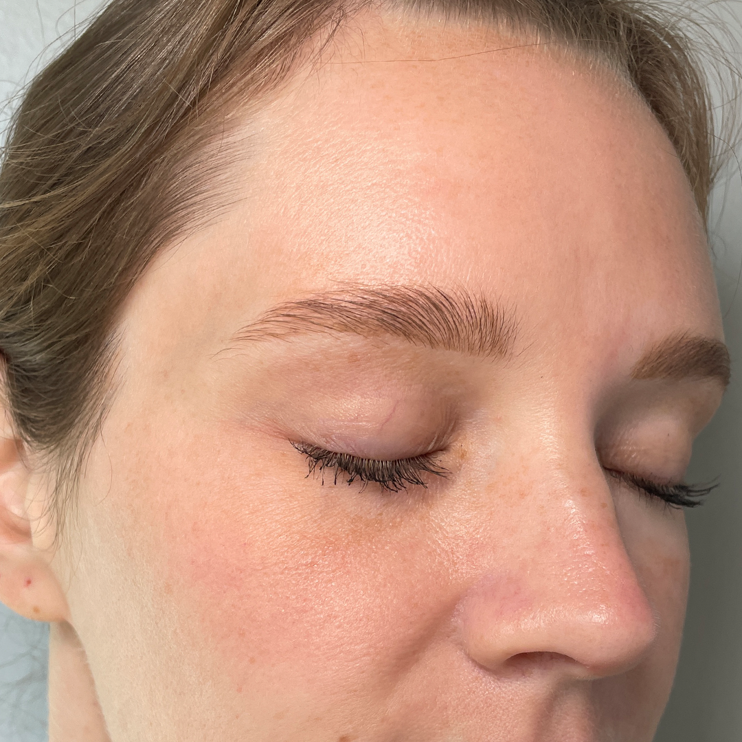 After Moxi laser treatment | Melasma skin treatments in Metairie, LA | Chronos BHW