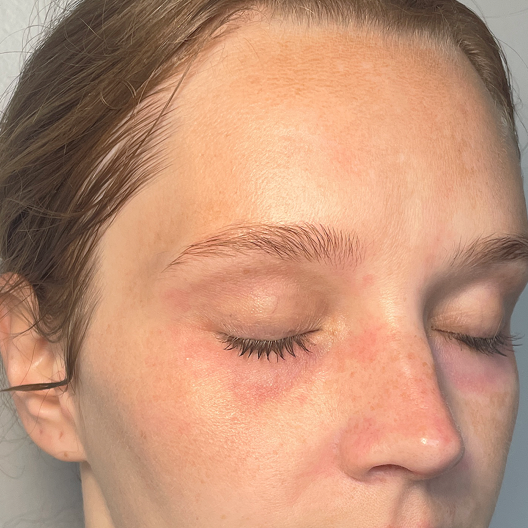 Moxi Laser treatment transformation in Metairie, LA | Chronos BHW