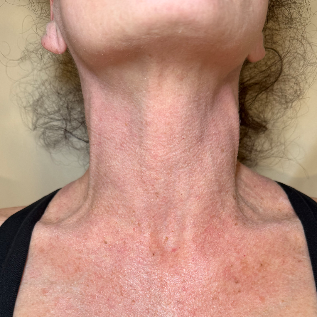 Sun damage laser treatment in Metairie and New Orleans | Chronos BHW