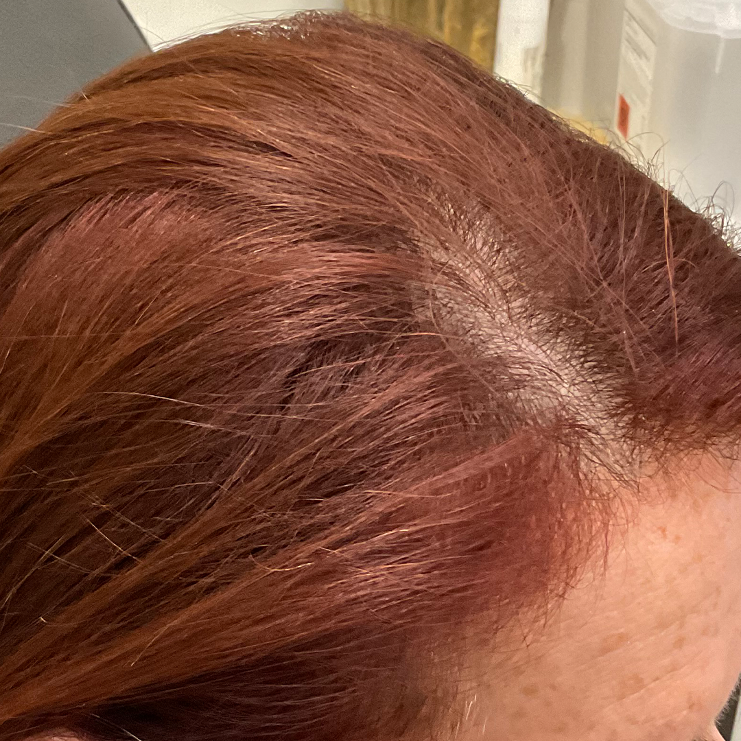 hair transformation | Thin hair treatment results | After photo | Chronos BHW