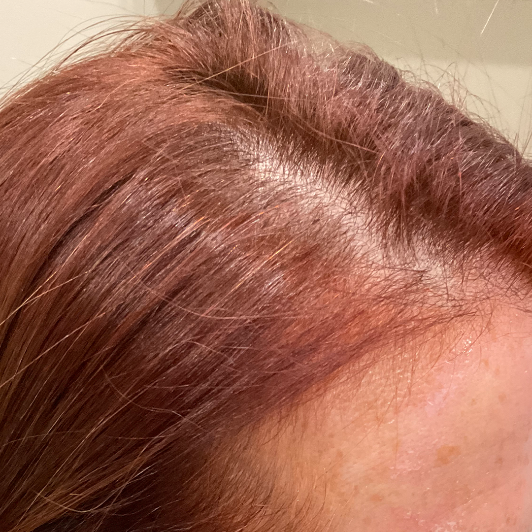 Hair restoration service transformation | Before photos | Chronos BHW | Metairie, LA