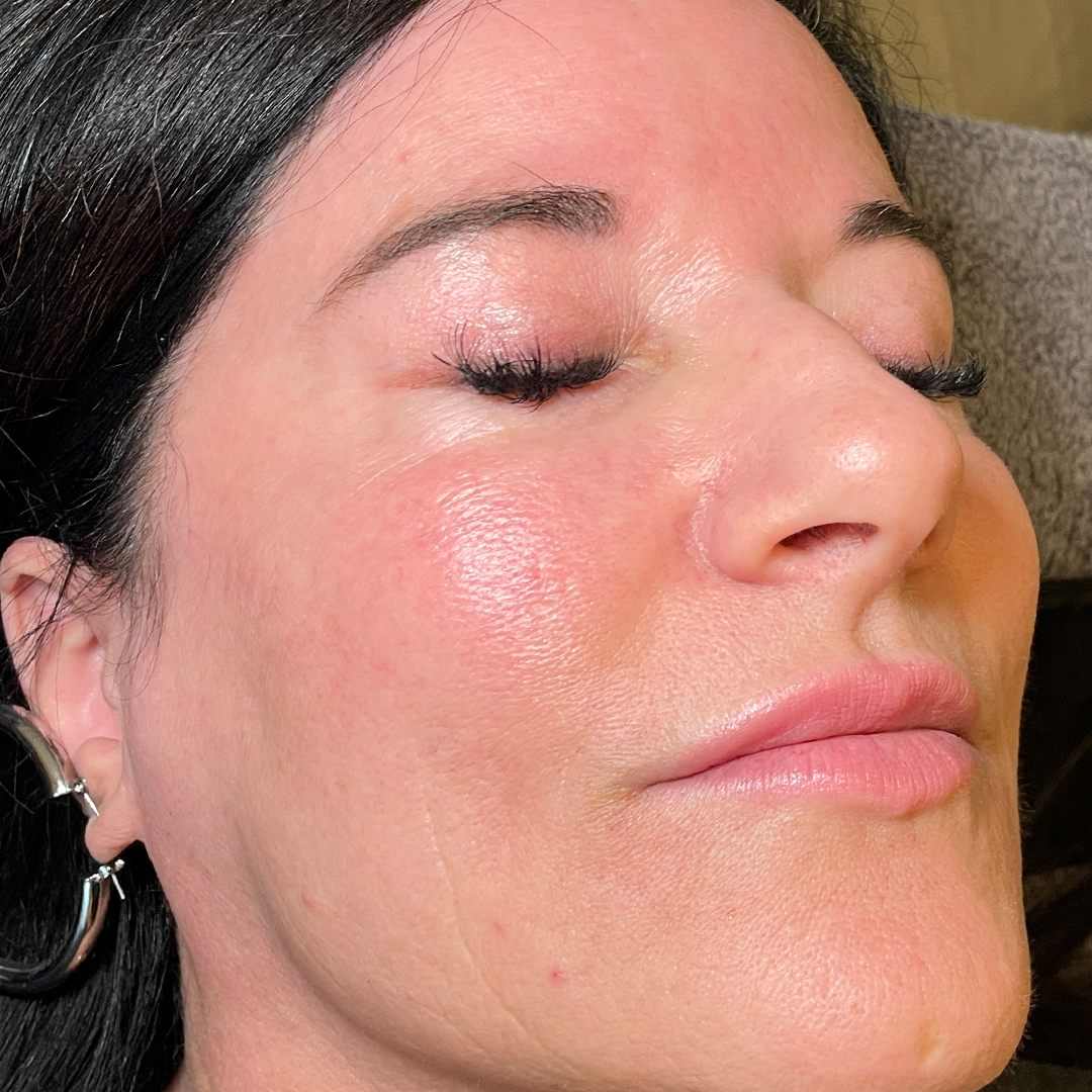 After BBL HEROic and Moxi laser treatment | Treat skin tone and texture in Metairie, LA | Chronos BHW