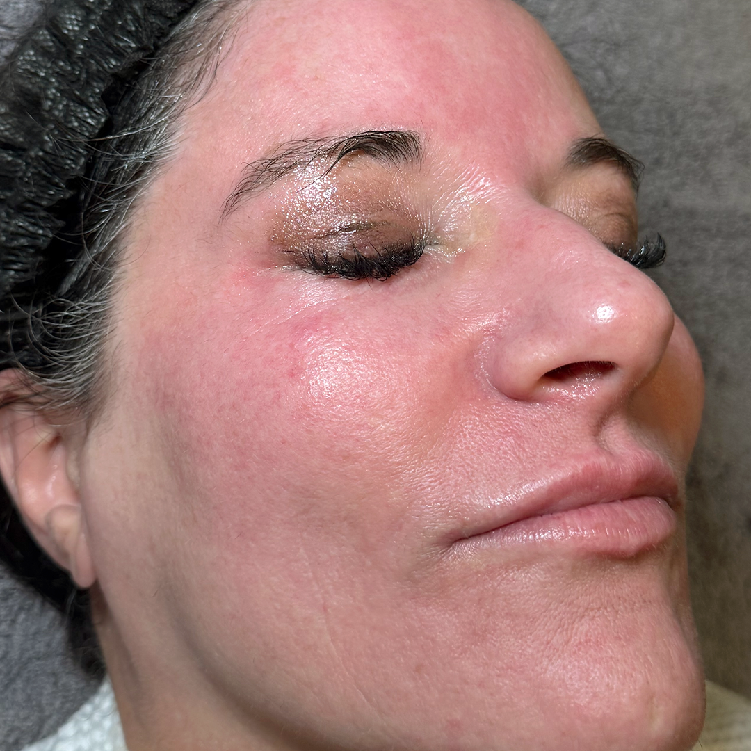 Moxi & BBL Treatments in Metairie | Chronos BHW | Sciton Laser treatments