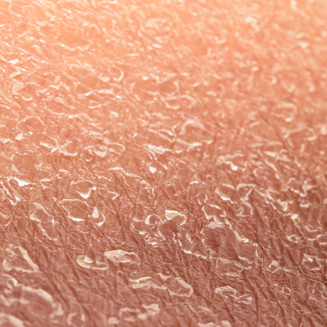 Dry skin treatments in Metairie Med Spa | Chronos BHW