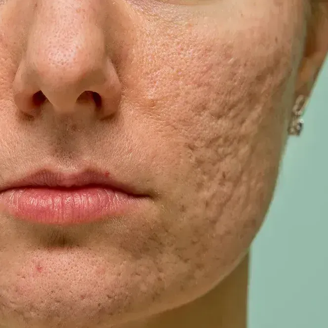 Acne Scarring and acne blemish breakout treatments | Treat acne | Med Spa | Metairie, LA