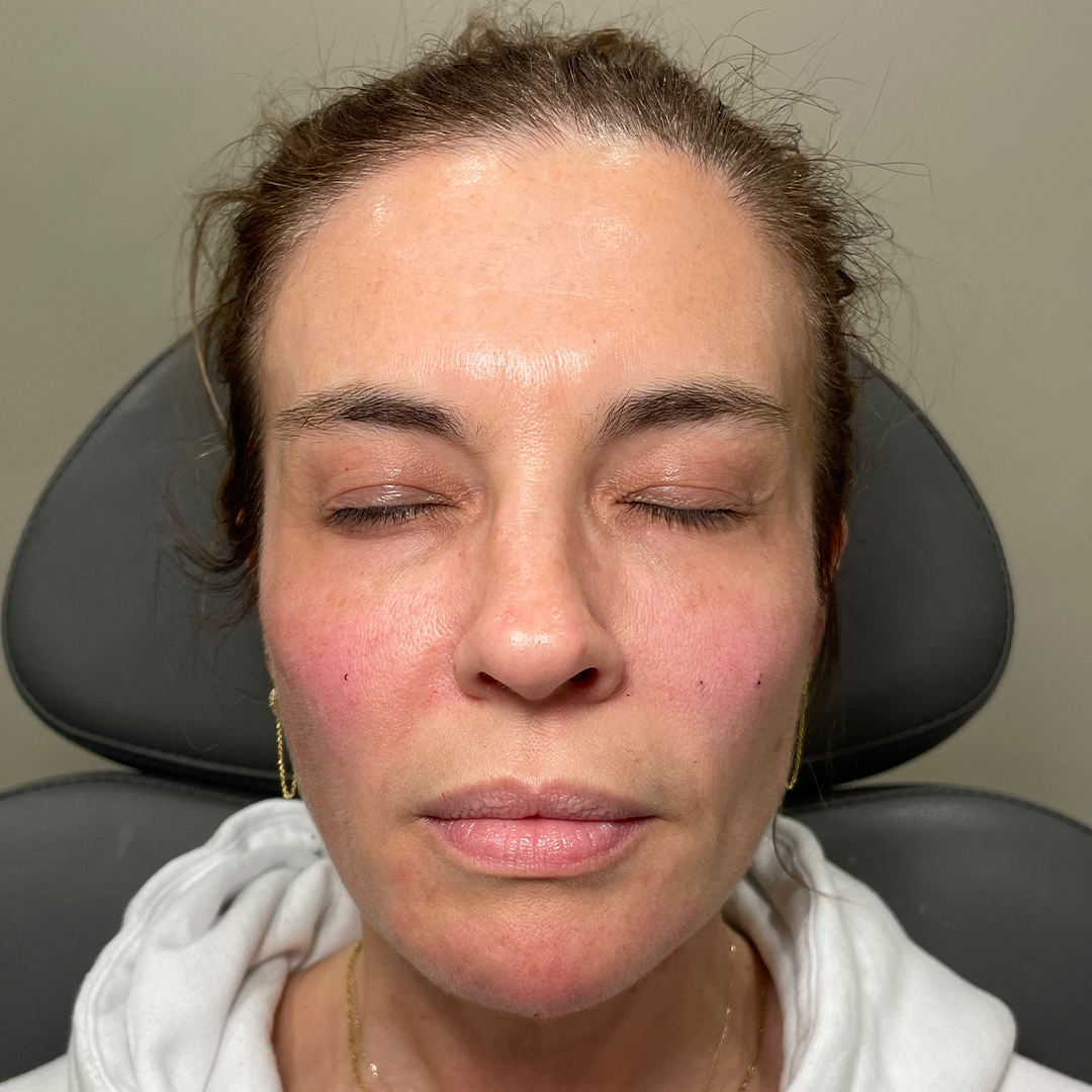 face balancing filler transformation | aesthetic injections in metairie, LA | filler transformation | Chronos BHW