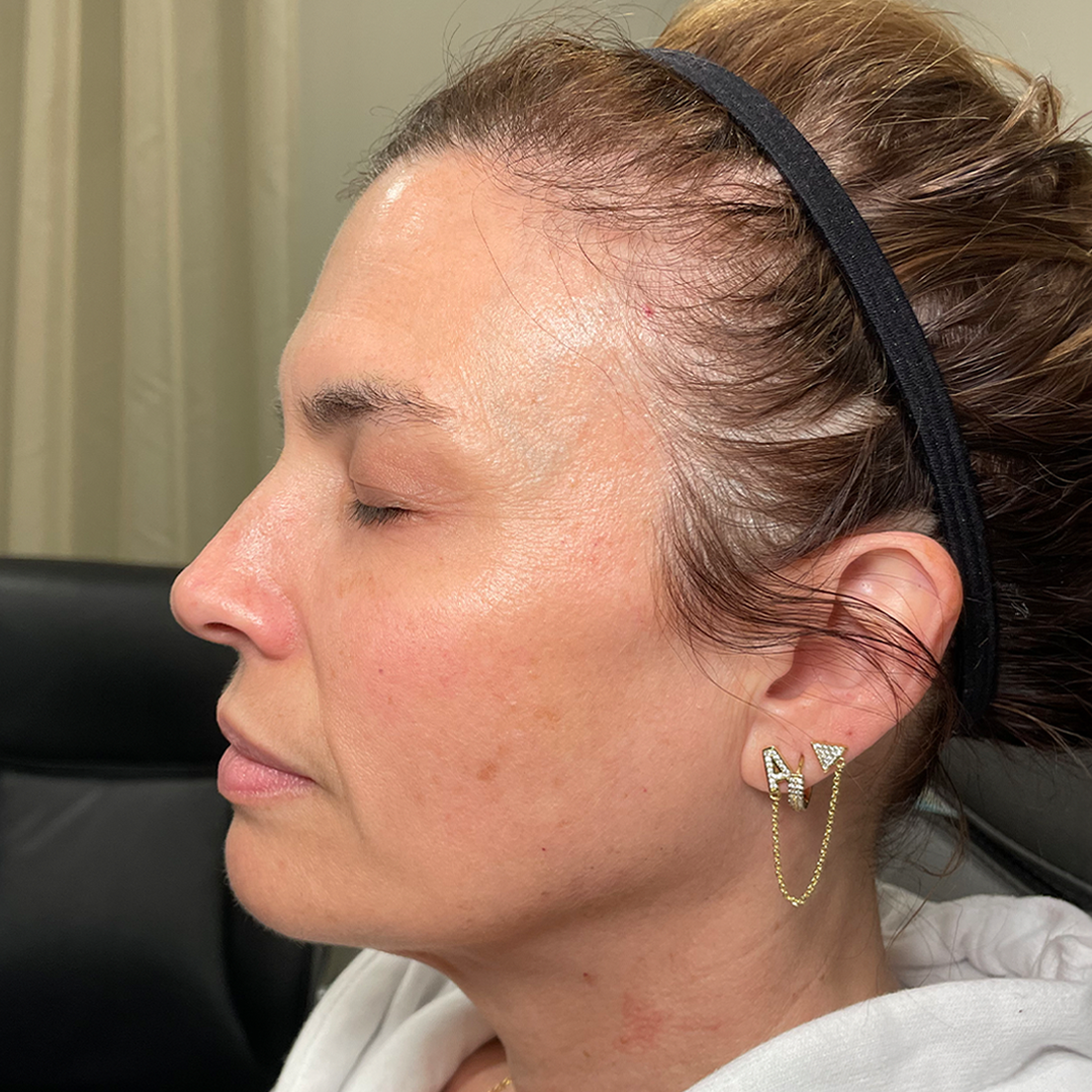 aesthetic injections in. metairie, LA | facial rejuvenation filler results