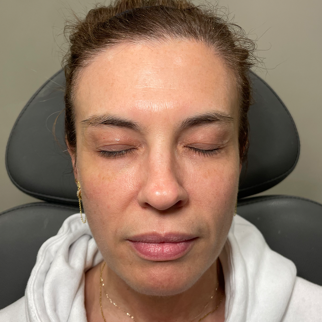 facial balancing filler in metairie, la | full face filler results | Cheek filler | Chronos BHW