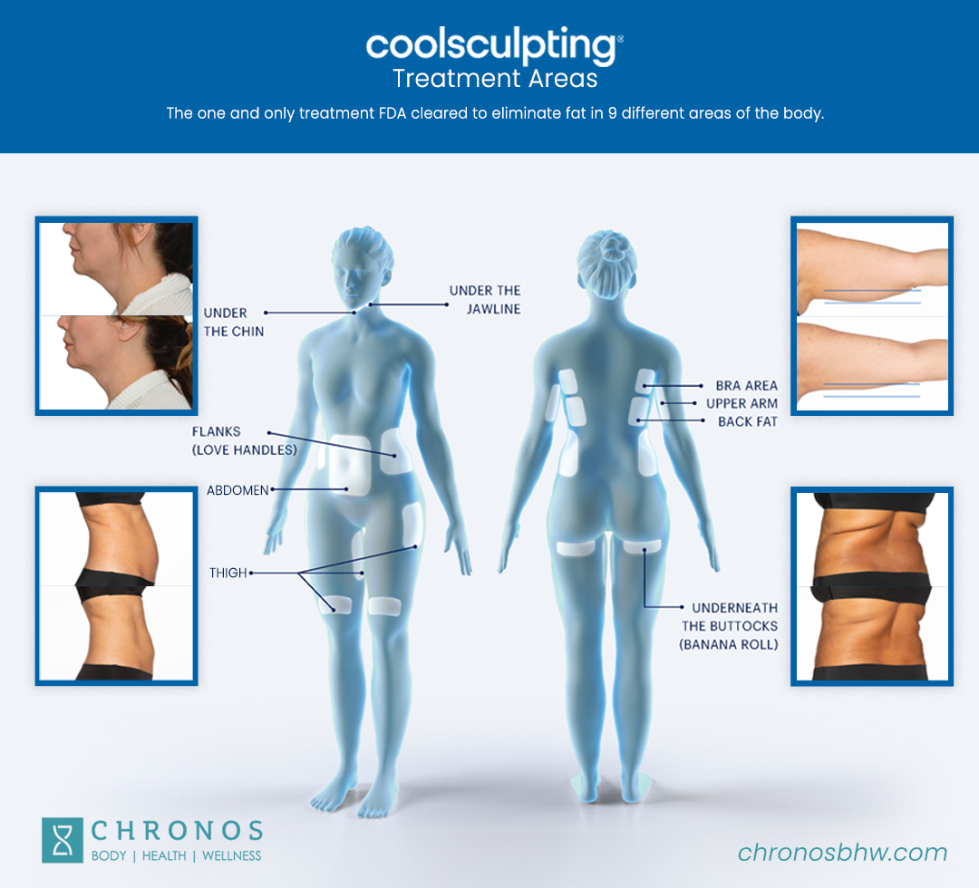 Coolsculpting treatment areas guide | CoolSculpting before and after | Metairie, LA | CHRONOS BHW