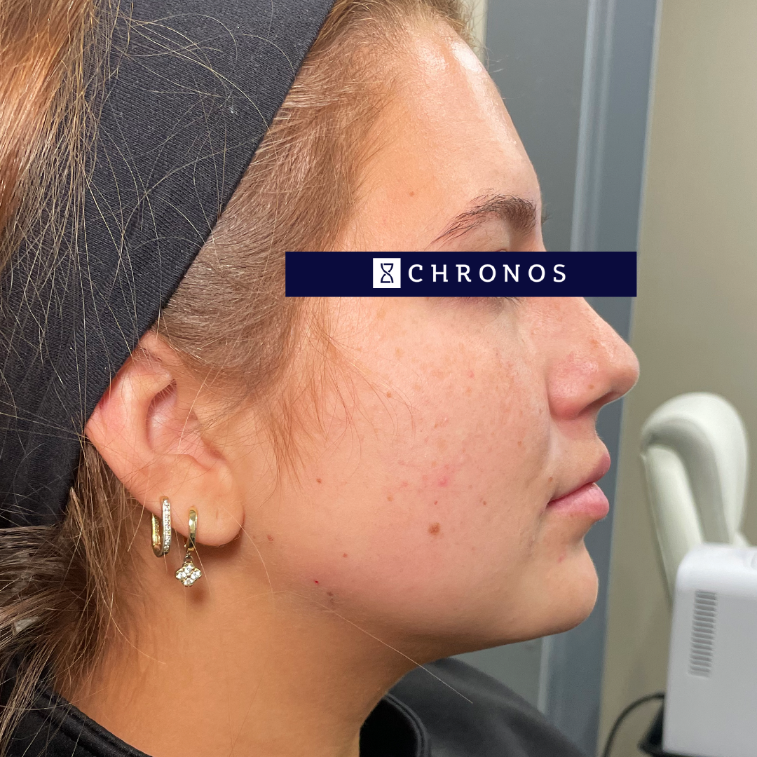 After photo of jaw and chin dermal filler in Metairie, LA at Chronos BHW | Define your jawline